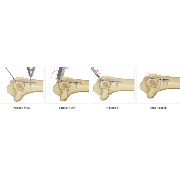 Elastic plate osteosynthesis 05 image