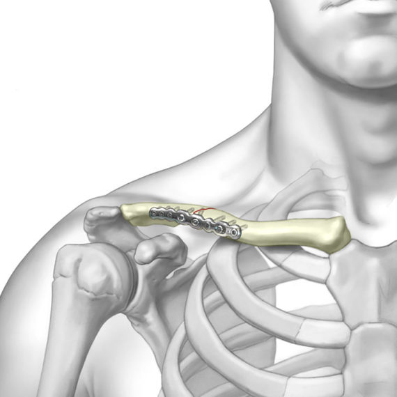 TriMed Clavicle Plate System CliniLab